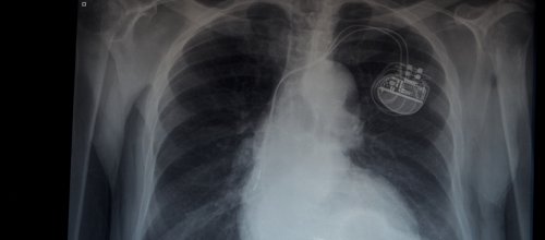 Herzschrittmacher_Röntgen