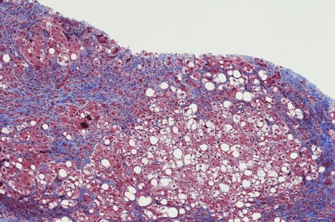 Leberzirrhose mit Lebersteatose und chronischer Hepatitis iStock