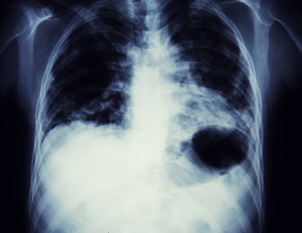Lungenkrebs Imagebild